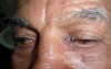 Basal Cell Carcinoma 