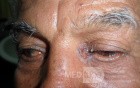Basal Cell Carcinoma 