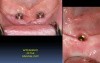 Mandibular Implant Overdenture Fabrication