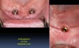 Mandibular Implant Overdenture Fabrication