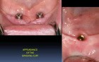 Mandibular Implant Overdenture Fabrication