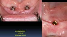 Mandibular Implant Overdenture Fabrication