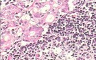 Adenocarcinoma of the cardias and gastric fundus with signet-ring cells (24 of 25)