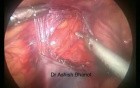 Varicocele Surgery
