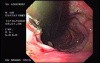 Schatzki Ring and Varices