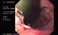 Schatzki Ring and Varices