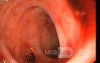 Bleeding From Sigmoid Diverticula