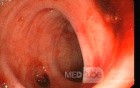 Bleeding From Sigmoid Diverticula