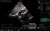 Patent Foramen Ovale (PFO)