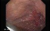 Reflux Esophagitis and Adenocarcinoma of the Antrum (1 of 3)
