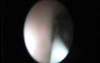 Retrograde Endopyelotomy - Part 1