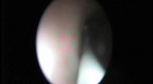 Retrograde Endopyelotomy - Part 1