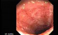 Endoscopy Of Ulcerative Colitis (2 of 3)