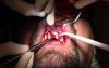 Extraction-Bone Grafting-CCL Surgery