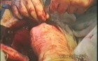Left Upper Lobectomy