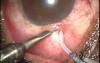 Transciliary Filtration - Mitomycin