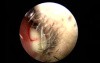 Nasal Septal Abscess - Unusual Presentation
