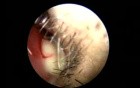Nasal Septal Abscess - Unusual Presentation