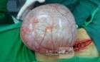 Left ovarian cyst