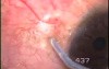 Bitot's spots removal