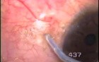 Bitot's spots removal