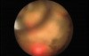 Ureteroscopy