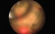 Ureteroscopy