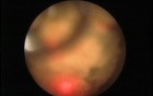 Ureteroscopy
