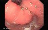 Duodenal Ulcer (1 of 5)