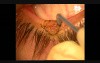 Bloodless excision of lid margin benign growths with Fugo plasma blade