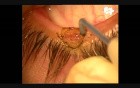 Bloodless excision of lid margin benign growths with Fugo plasma blade
