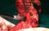 Supracolic Removal of the Omentum for Ovarian Cancer by Use of Sealing of Blood Vessels