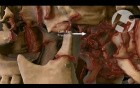 Severe Skull Fractures