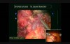 Robotic Whipple Procedure: Details of Technique