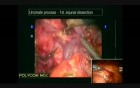 Robotic Whipple Procedure: Details of Technique