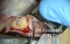 Implant Microsurgery featuring Zimmer Sinus Lateral Approach Kit