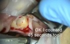 Implant Microsurgery featuring Zimmer Sinus Lateral Approach Kit