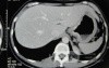 Endoscopy of Scirrhous Gastric Carcinoma involving the entire Fundus, Body and the Antrum (20 of 47)