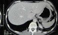 Endoscopy of Scirrhous Gastric Carcinoma involving the entire Fundus, Body and the Antrum (20 of 47)