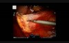 Robotic excision of a large retroperitoneal schwannoma