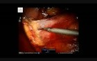 Robotic excision of a large retroperitoneal schwannoma
