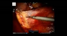 Robotic excision of a large retroperitoneal schwannoma