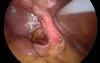 SILS appendectomy