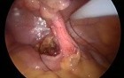 SILS appendectomy