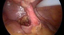 SILS appendectomy
