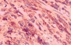 Gastrointestinal Stromal tumor (GIST) (62 of 65)