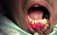 Sling Suturing Of Native Tissues - Gingival Grafting #26-25-24
