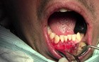 Sling Suturing Of Native Tissues - Gingival Grafting #26-25-24
