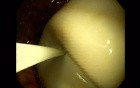 Endoscopic Balloon Removal (2 of 9)