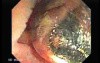 Dental Prothesis Found in the Jejuno (1 of 9)